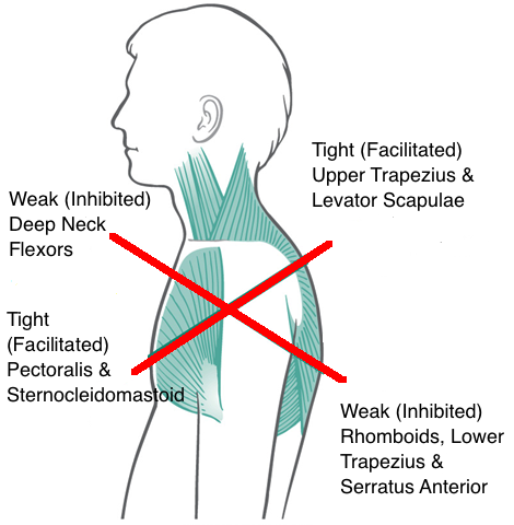 Upper cross syndrome